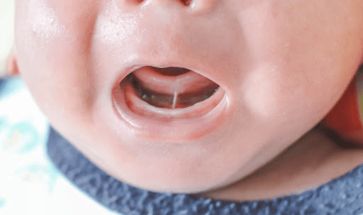 tongue and lip tie surgery