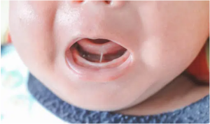 My Pedia Clinic - Our Blog 5 Tongue Tie Surgery